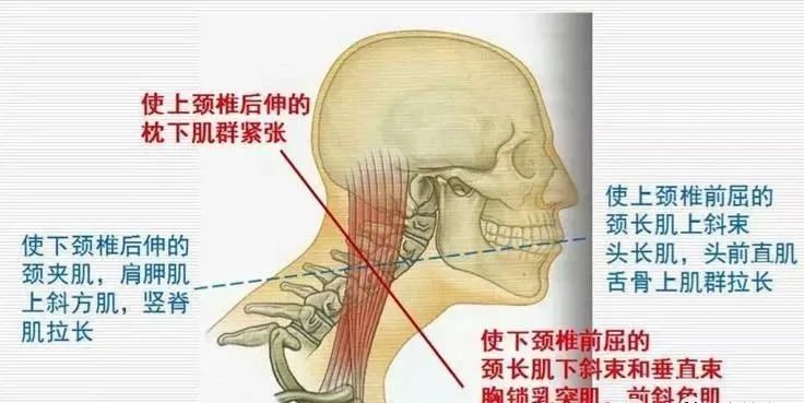 總感覺活在夢境之中,不真實; 頭頸肌肉緊張間接的參與構成上交叉綜合