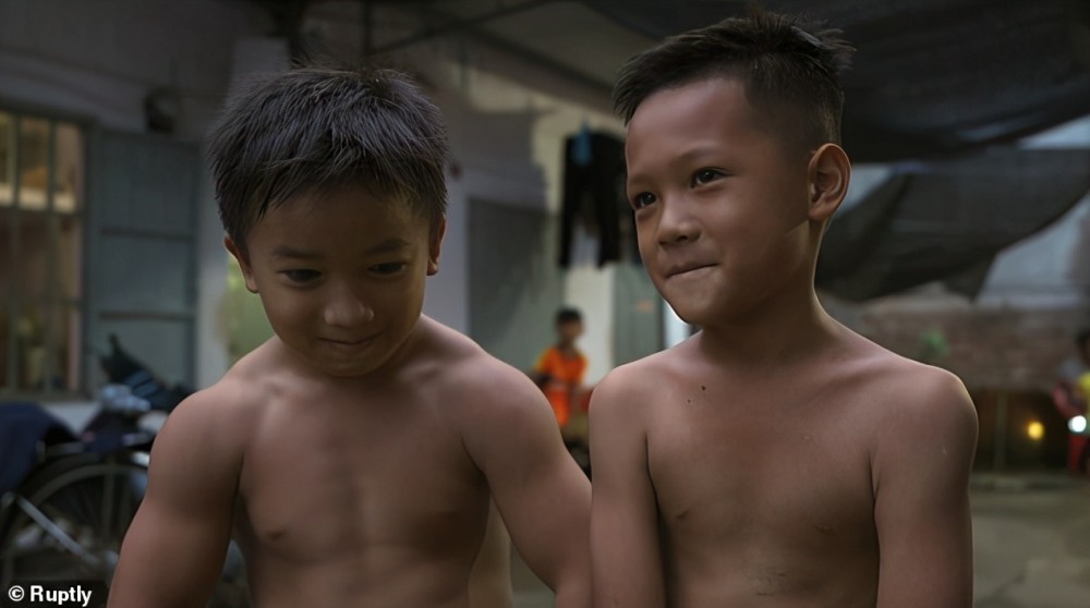 越南十岁男孩患罕见遗传病肌肉过度生长媲美专业健美运动员