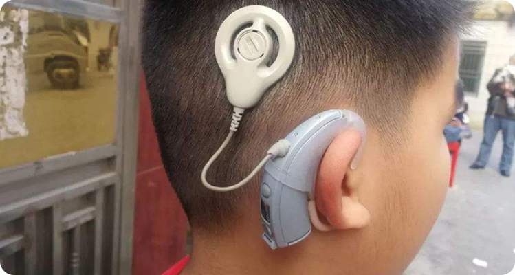 耳鼻喉科:耳聋患者应该选择人工耳蜗还是助听器_腾讯新闻
