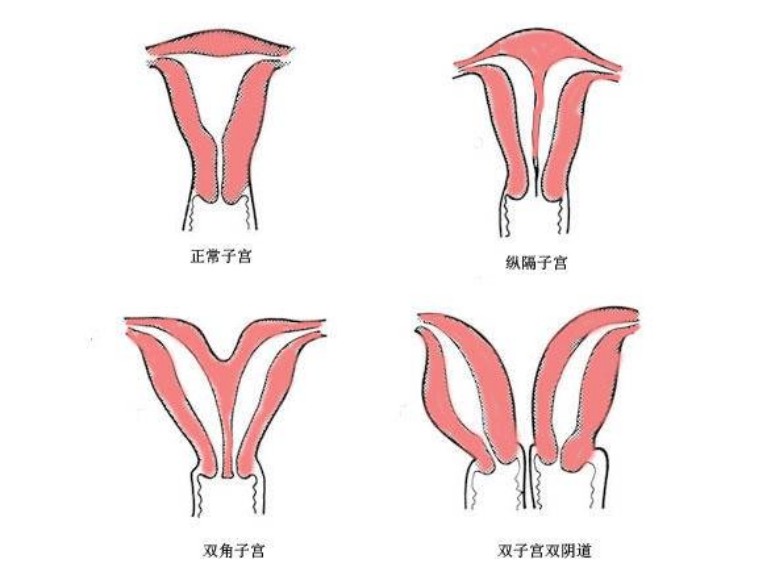 竟然有"双子宫"的女人,什么原因引起的?她还能正常生育吗?