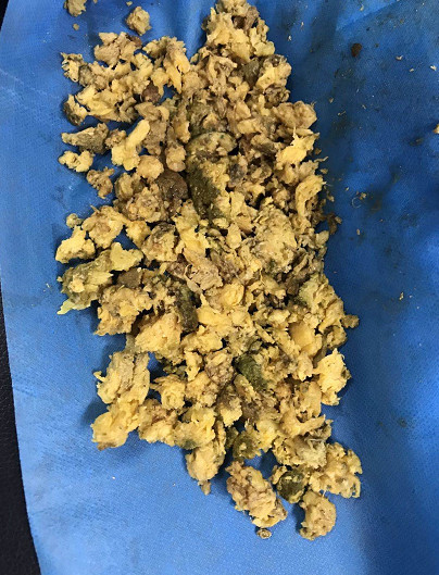 吃柿子吃出10厘米巨大胃结石图片扎心慎入