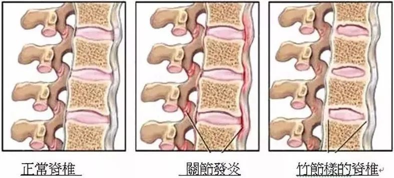 强直性脊柱炎|“强直性脊柱炎到40岁以后就不发展了” 是真的吗？