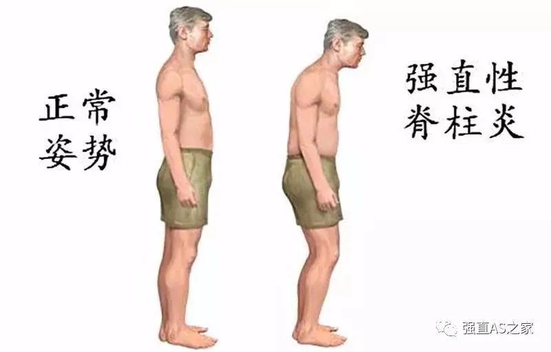 强直性脊柱炎|“强直性脊柱炎到40岁以后就不发展了” 是真的吗？