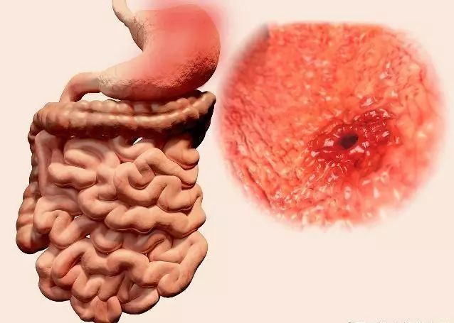 糜烂性胃炎|慢性糜烂性胃炎若不及时治疗，将会带来这3大危害