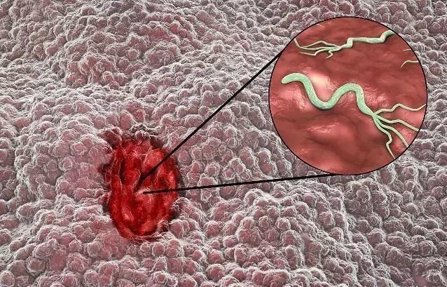 糜烂性胃炎|慢性糜烂性胃炎若不及时治疗，将会带来这3大危害