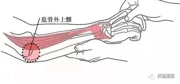 肱骨|肱骨外上髁炎诊疗技术