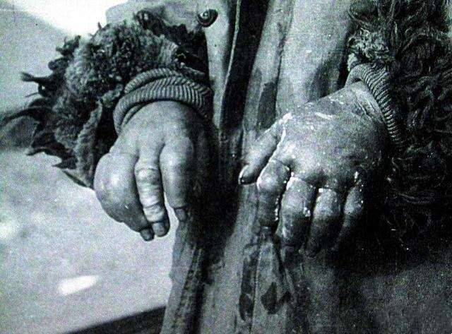 中国机长|皮肤被冻伤，处理能挽救生命！医生告诉你如何防治