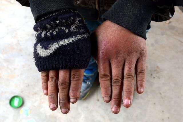 中国机长|皮肤被冻伤，处理能挽救生命！医生告诉你如何防治