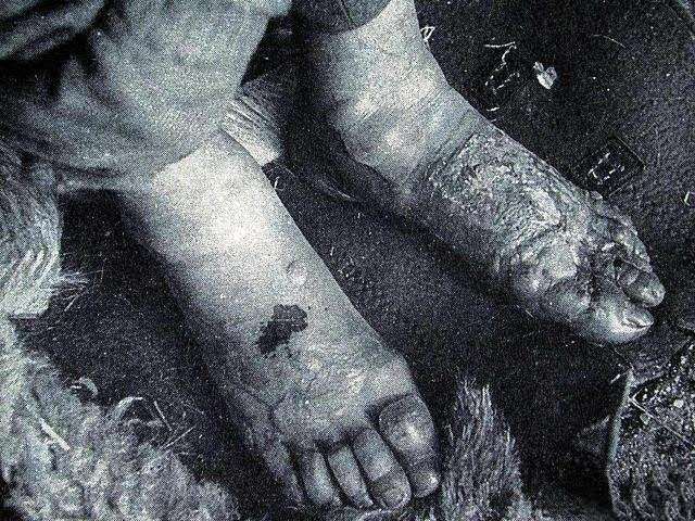 中国机长|皮肤被冻伤，处理能挽救生命！医生告诉你如何防治