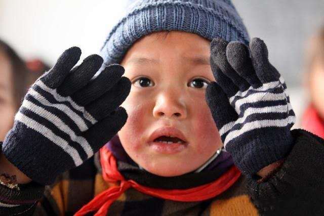 中国机长|皮肤被冻伤，处理能挽救生命！医生告诉你如何防治