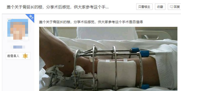 医生|矮真的会自卑？那些断骨增高的人，后来怎么样了？