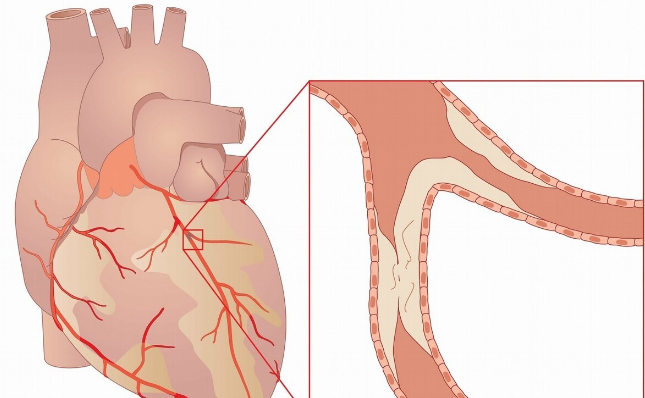 血脂|血脂正常，发现颈动脉斑块需要吃他汀吗？医生：还需评估后确定