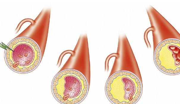 血脂|血脂正常，发现颈动脉斑块需要吃他汀吗？医生：还需评估后确定