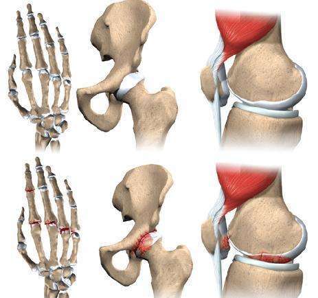 类风湿疾病早期即可出现骨端的骨质疏松表现,以关节近端的骨质出现