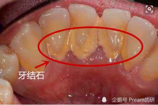 牙齦出血牙齒變黑牙齒疼痛這些症狀千萬要注意