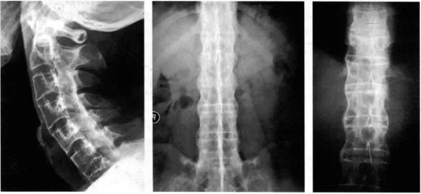 强直性脊柱炎|NSAIDs在强直性脊柱炎治疗中的应用