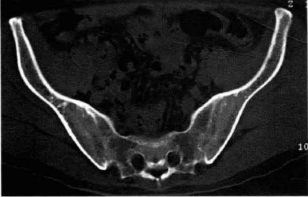 强直性脊柱炎|NSAIDs在强直性脊柱炎治疗中的应用