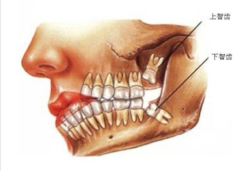 智齿|人类是否还在进化，科学家研究发现越来越多的新生儿没有智齿