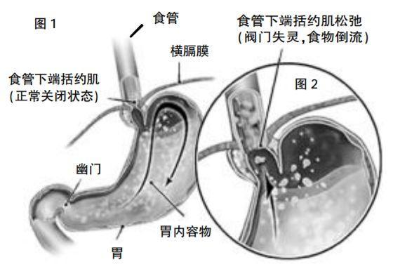 胃食管反流|饭后烧心、泛酸可能发展成“癌”，远离6种食物胃会感谢你