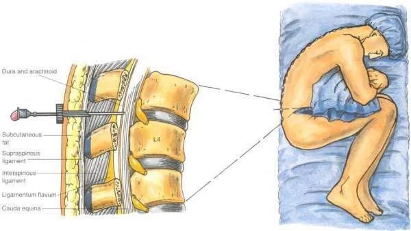 无痛分娩|从“地狱”到“天堂”，无痛分娩最真实的体验！