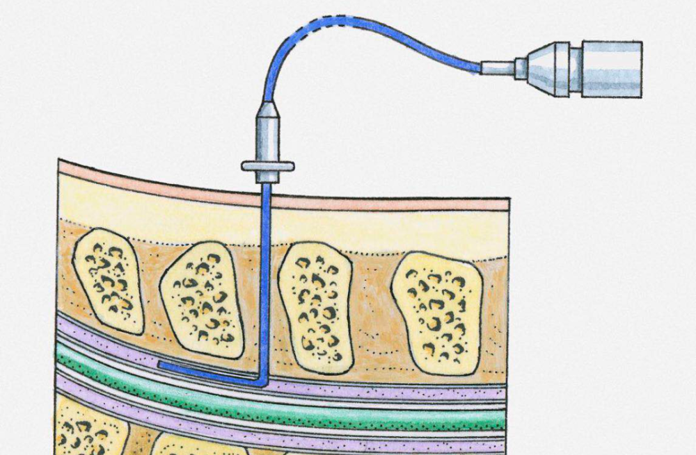 无痛分娩|从“地狱”到“天堂”，无痛分娩最真实的体验！