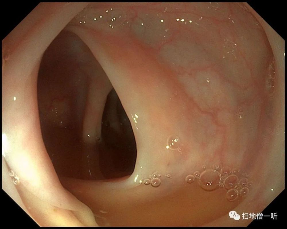直肠里的瘪气球