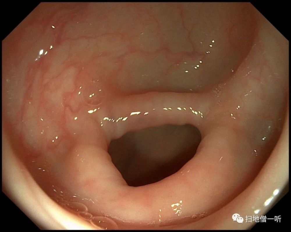 肠镜阑尾开口正常图片图片