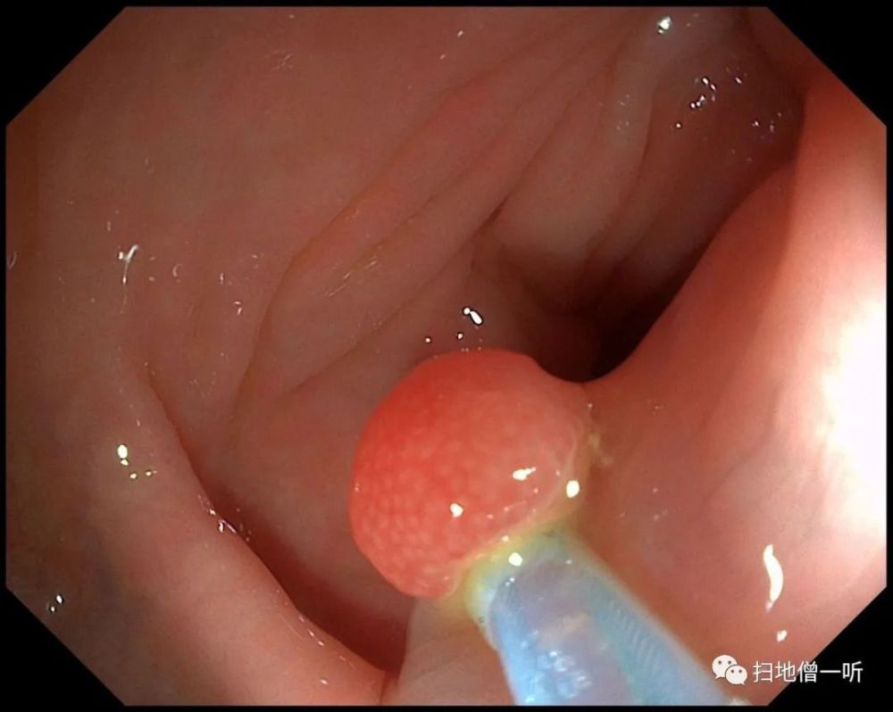 直肠里的瘪气球