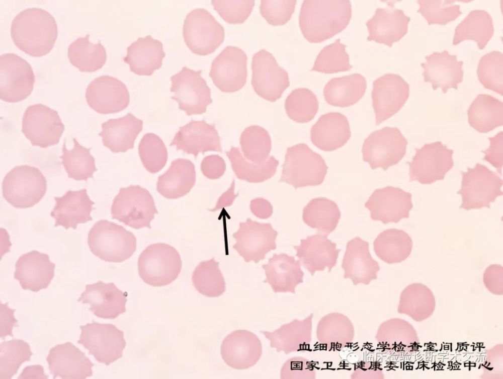 卫健委临检中心2020年血细胞形态学检查室间质量评价及答案