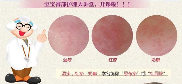 尿布疹其实根据诱因不同,可以分为刺激物引起的接触性皮肤炎,白色念