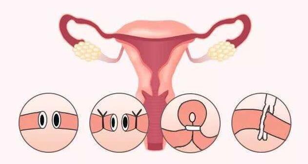 女性不孕症输卵管严重堵塞能顺利做试管婴儿吗？