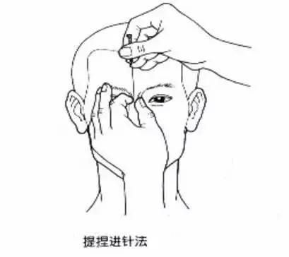 揭开针灸的神秘面纱想学和初识针灸的必看