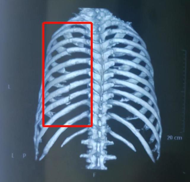 摔一跤 折7根肋骨 医生凭什么让患者回家了 真的不需要治疗吗 医生 肋骨骨折 连枷胸 手术治疗