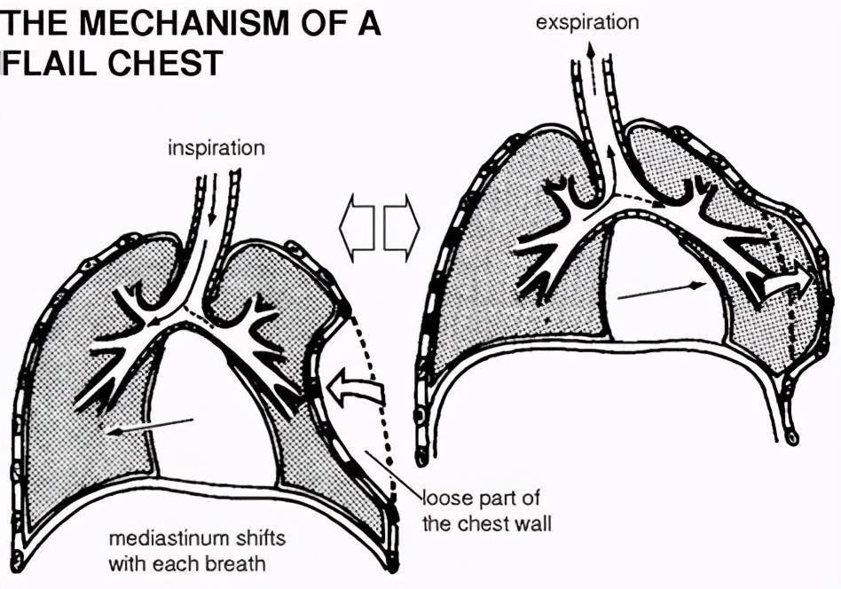 就是一個範圍內好多處骨折,這個時候骨折的部位並不能足以支撐起胸廓