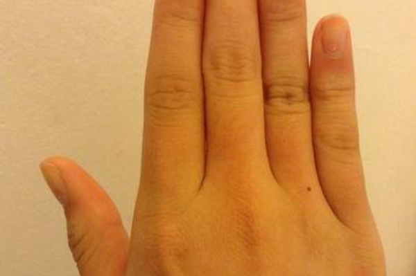 女人右手食指有痣图片