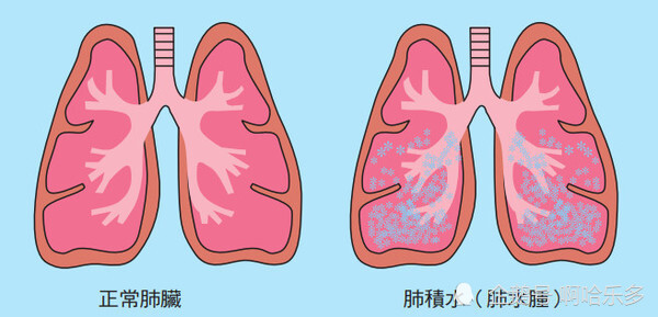 唐跃良|肺里有积水该怎么办 唐跃良？