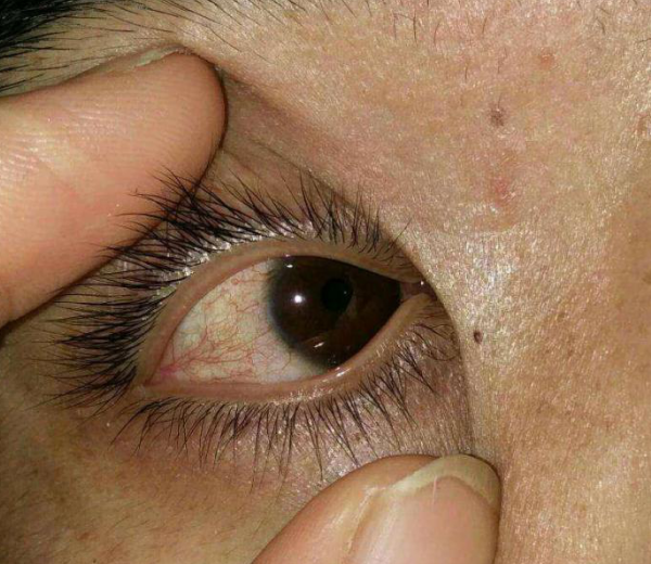 肝癌来临身上会有5处异常或是身体求救信号不容忽视