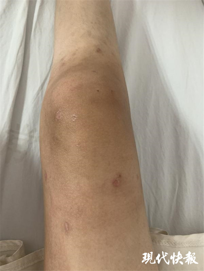 女童膝盖肿胀如馒头,竟是幼年特发性关节炎
