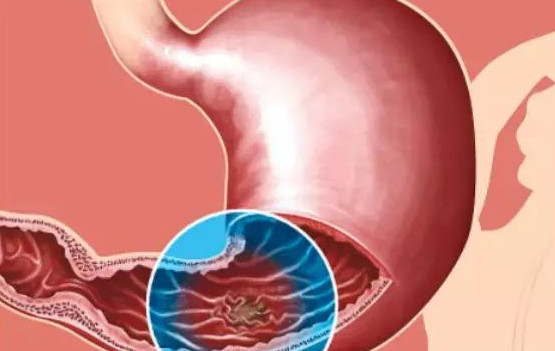 有这些症状代表你得了胃溃疡 消化内科