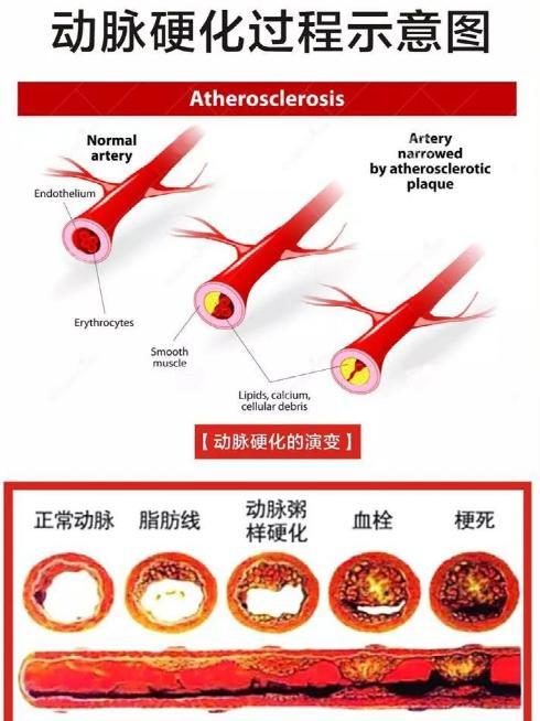 心脑血管疾病|吃盐越少越健康？不一定！“错误吃盐”每年害死很多人