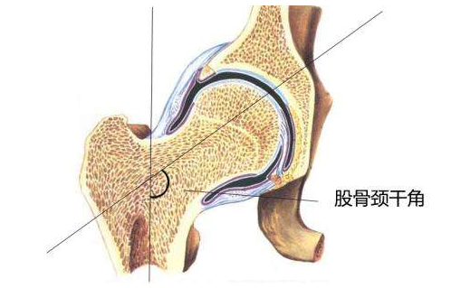 还有就是股骨颈干角:正常股骨有一个15°的前倾角,如果股骨前倾角比较