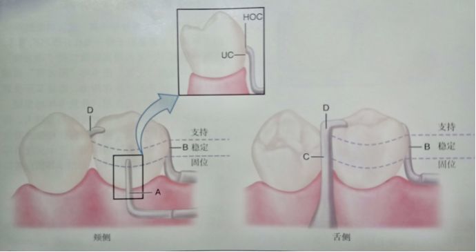 (2)杆形卡環臂:從齦方進入固位倒凹(圖3).