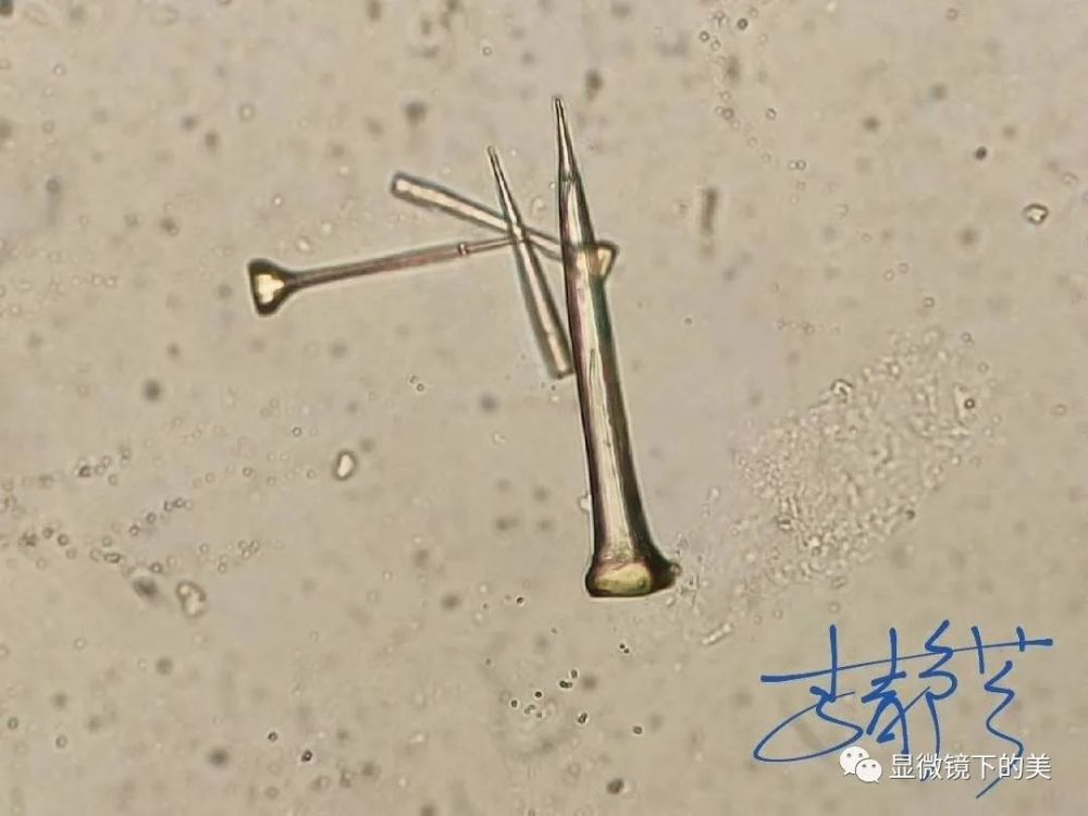 钉子样的尿酸结晶,看着都疼!