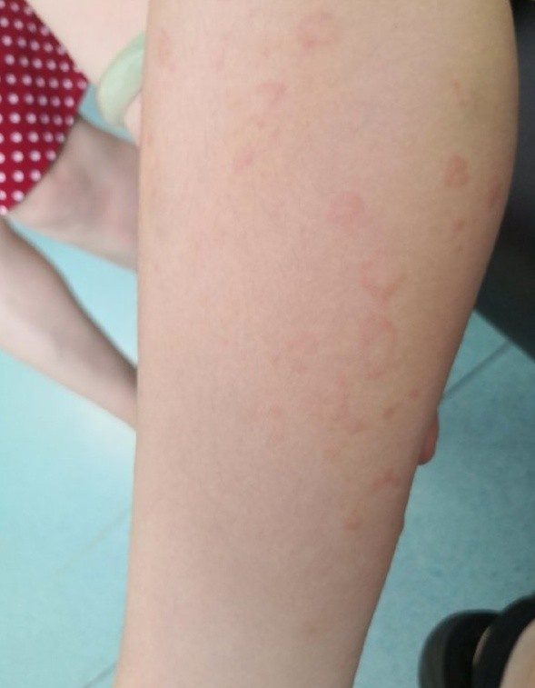 人工荨麻疹能用身体乳吗(荨麻疹皮肤干燥可以用身体乳吗)