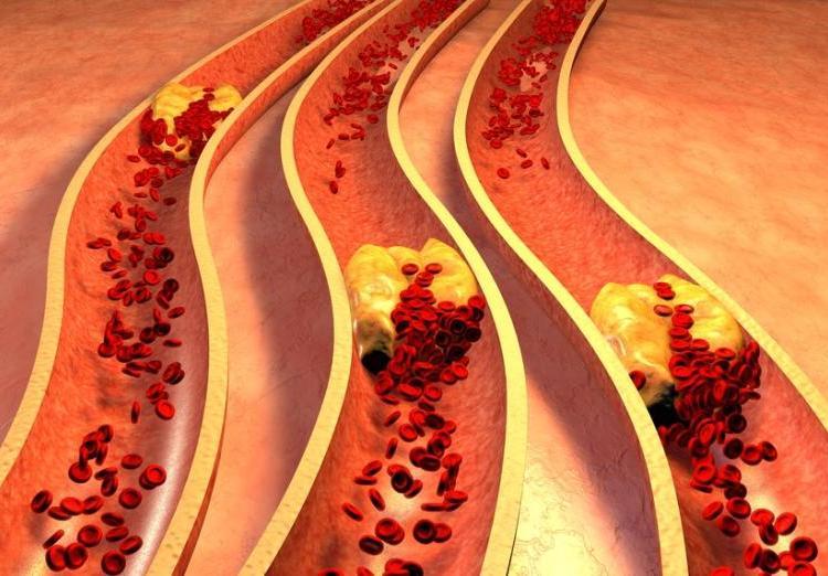 家常菜|入秋前后，心血管最敏感，不想血管出问题，5道家常菜尽量少吃