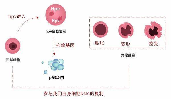 hpv61陽性是什麼意思?hpv61是怎麼引起的?