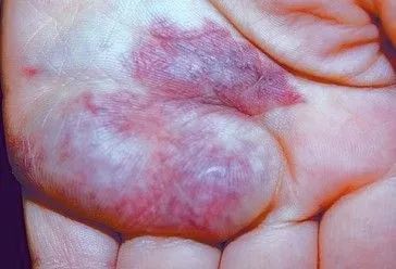 形成脉管畸形,位置深浅不一,属最多见的血管畸形