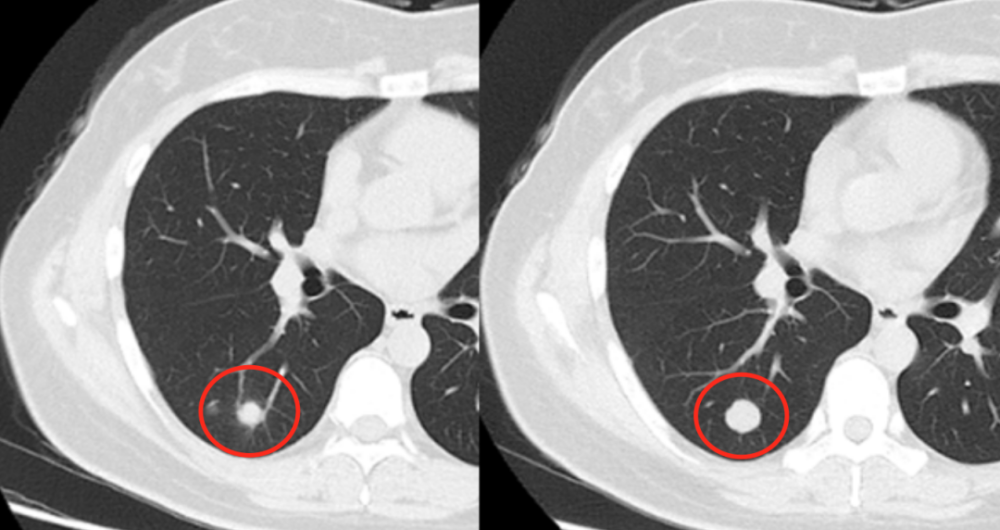 ct查出肺结节有什么手段辅助查性质为什么有的肺癌不是结节也要切