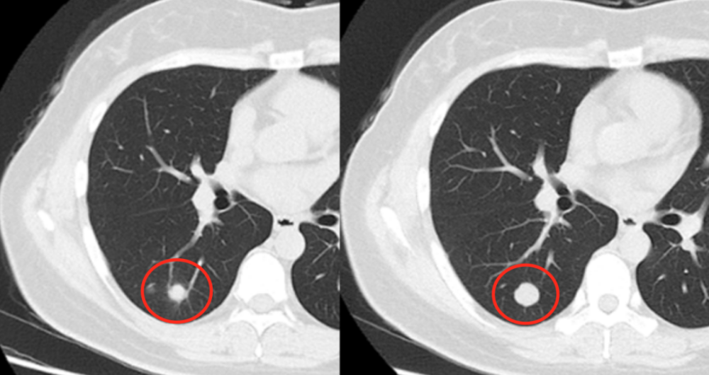 良性肺结节ct图图片