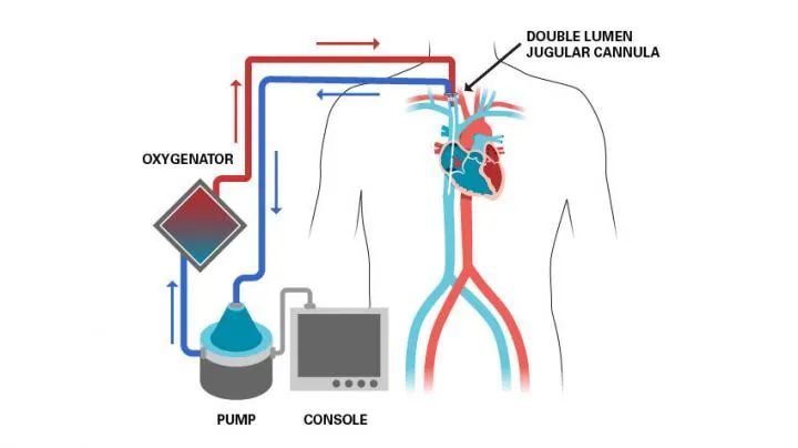 ecmo治疗新冠危重症,用处到底多大《柳叶刀》发表大型国际研究结果